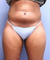 CoolSculpting