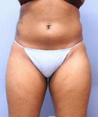 CoolSculpting