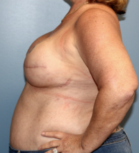 Skin Sparing Reconstruction