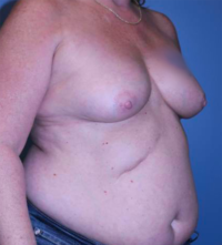 Skin Sparing Reconstruction