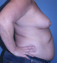 Skin Sparing Reconstruction