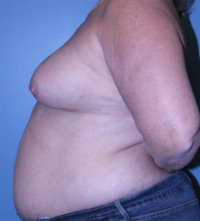 Skin Sparing Reconstruction