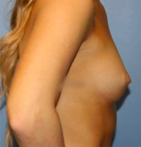 Breast Augmentation