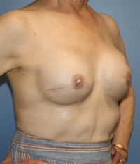 Skin Sparing Reconstruction