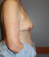 Skin Sparing Reconstruction