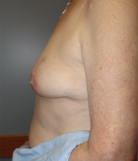 Skin Sparing Reconstruction