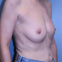 Nipple Sparing Reconstruction