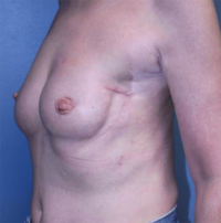 Nipple Sparing Reconstruction