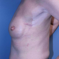 Nipple Sparing Reconstruction