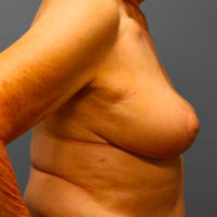 Oncoplastic Breast Reconstruction