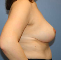 Breast Reduction