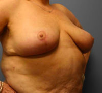 Breast Reduction