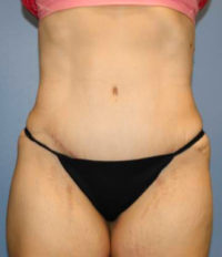 Tummy Tuck