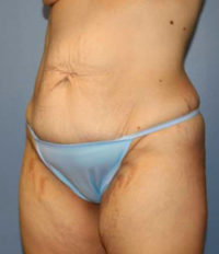 Tummy Tuck