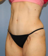 Tummy Tuck