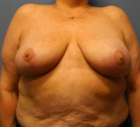 Breast Reduction