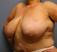 Breast Reduction