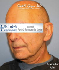 Face & Neck Lift