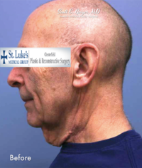 Face & Neck Lift