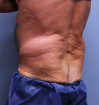 CoolSculpting