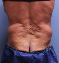 CoolSculpting