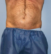 CoolSculpting