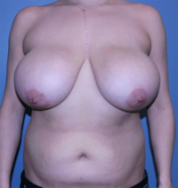 Breast Reduction