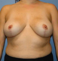 Breast Reduction