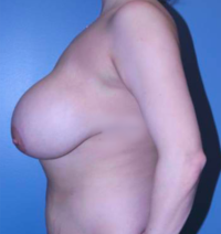 Breast Reduction