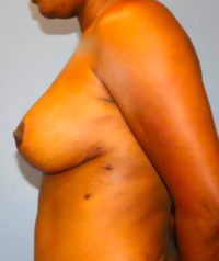 Breast Reduction