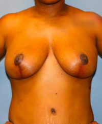 Breast Reduction