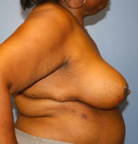 Oncoplastic Breast Reconstruction