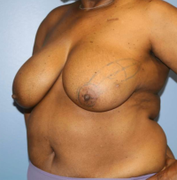 Oncoplastic Breast Reconstruction