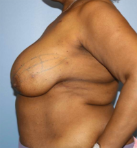 Oncoplastic Breast Reconstruction