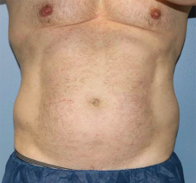 Liposuction Case 3370 Before Photo Liposuction