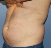 Liposuction