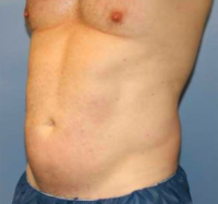 Liposuction