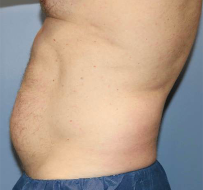 Liposuction Case 3370 Before Photo Liposuction