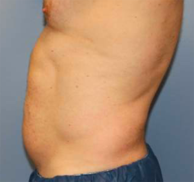 Liposuction Case 3370 After Photo Liposuction
