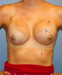 Nipple Sparing Reconstruction