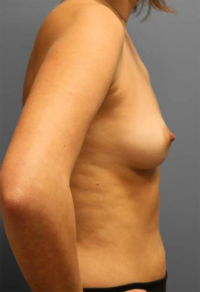 Nipple Sparing Reconstruction