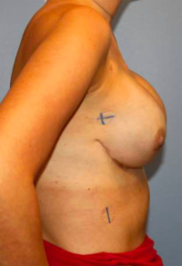 Nipple Sparing Reconstruction