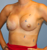 Nipple Sparing Reconstruction