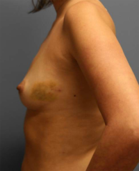 Nipple Sparing Reconstruction