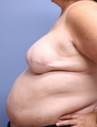 Skin Sparing Reconstruction