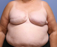 Skin Sparing Reconstruction