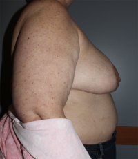 Skin Sparing Reconstruction