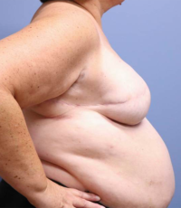 Skin Sparing Reconstruction