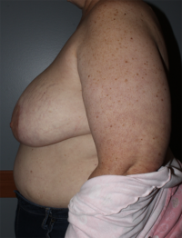 Skin Sparing Reconstruction