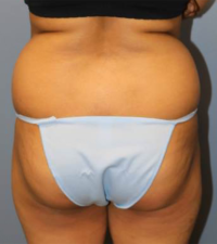 Tummy Tuck